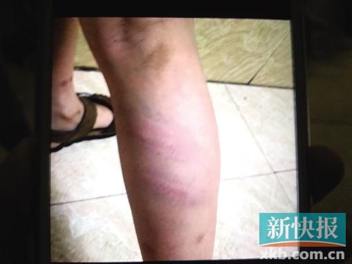 小宇腿部有明顯瘀痕。 翻拍自家屬手機