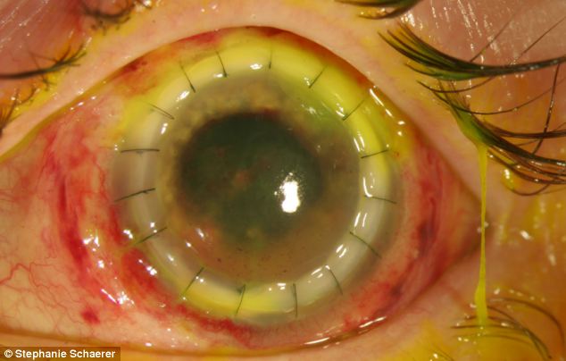 恐怖慎入！隱形眼鏡致英女子摘除眼球