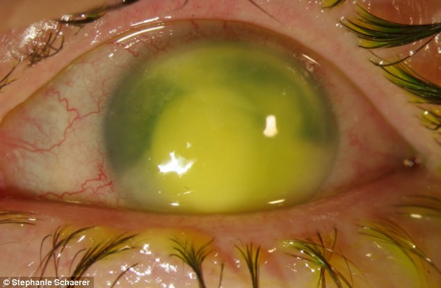 恐怖慎入！隱形眼鏡致英女子摘除眼球