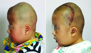 術(shù)前（左），術(shù)后（右）