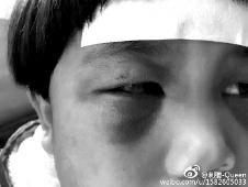 6月2日，網(wǎng)曝渭南市臨渭區(qū)一不滿5歲的女童遭奶奶毆打，眼圈青腫，引起網(wǎng)友關(guān)注，但孩子父母和爺爺均稱是摔倒導(dǎo)致。相關(guān)部門介入調(diào)查發(fā)現(xiàn)確為奶奶毆打所致，鑒于其身體原因已進(jìn)行批評教育。