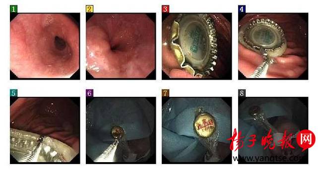 男子喝酒太猛吞下瓶蓋 醫(yī)生用避孕套取出 男子喝酒太猛吞下瓶蓋 醫(yī)生用避孕套取出