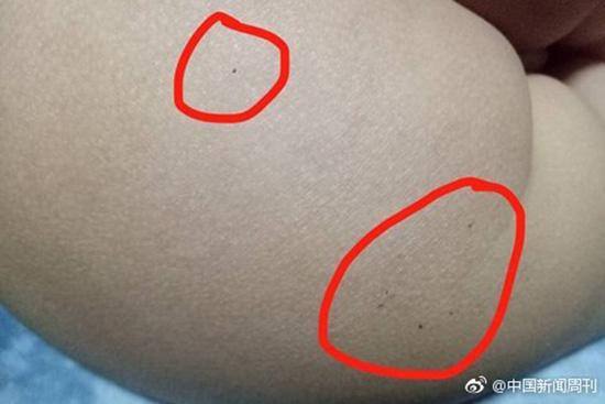據(jù)多名紅黃藍(lán)(新天地分園)家長反映，孩子腿部、屁股、腋下出現(xiàn)針眼。