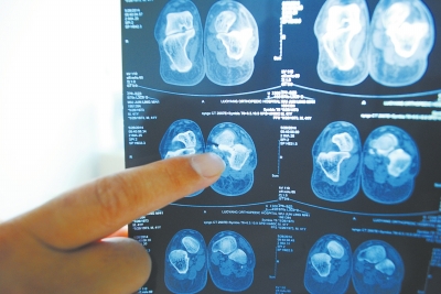 X光片顯示,確實(shí)有一根殘留的螺絲釘。