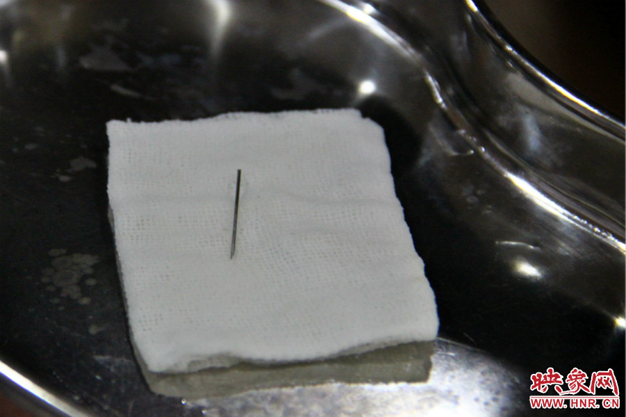 上午11點30分許，小龍腦中鋼針已經(jīng)成功取出。