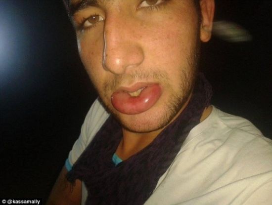 IS被指在敘利亞使用化學(xué)武器 有居民失明起水泡 IS被指在敘利亞使用化學(xué)武器 有居民失明起水泡