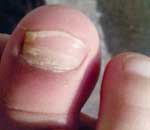 一幼兒園兒童“指甲異?！? title=